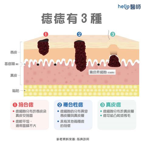 痣怎麼來的|為什麼臉上的痣越來越多？皮膚科醫師解析長痣原因、。